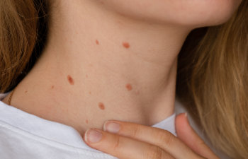 woman showing her birthmarks on neck skin